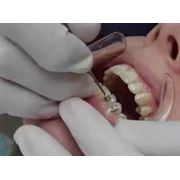 Протезирование зубов несъемное (брекет-системы)