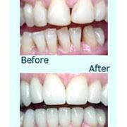 Косметическое восстановление зубов фотография