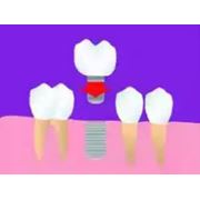 Имплантация и протезирование зубов на имплантатах фотография