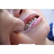 Протезирование зубов в Алматы фото