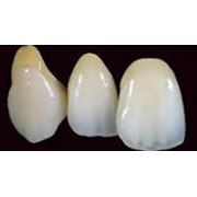 Протезирование зубов: Металлокерамика Стоматологические услуги Ортопедическая стоматология фото