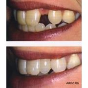 Протезирование зубов несъемное фотография