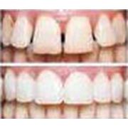 Микропротезирование прямые виниры Стоматологические услуги Ортопедическая стоматология фото