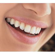 Лечение кариеса некариозных поражений зубов фото