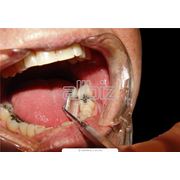 Лечение кариеса некариозных поражений зубов в Алматы фото
