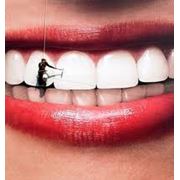 Отбеливания зубов
