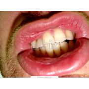 Лечение кариеса некариозных поражений зубов в Алматы фото