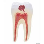 Лечение деструктивных поражений тканей зуба в алматы фото