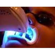 Лазерное отбеливание зубов фото