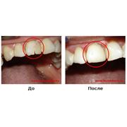 Реставрация зуба Стоматологические услуги Терапевтическая стоматология фото