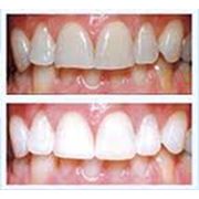 Лазерное отбеливание зубов Стоматологические услуги фотография