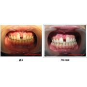 Пластика уздечек языка верхней нижней губ Стоматологические услуги Стоматология фото