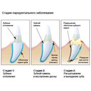 ХИРУРГИЧЕСКОЕ ЛЕЧЕНИЕ ЗАБОЛЕВАНИЙ ПАРОДОНТА