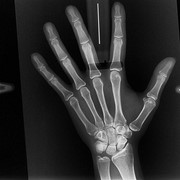 Рентгенограмма костей кисти фото