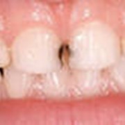 Серебрение зубов в алматы