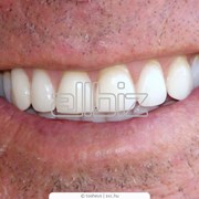 Протезирование зубов. фото