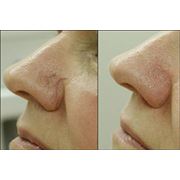 Удаление папилом бородавокневусоврасширенных сосудов кожи лица фото