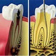 Лечение пульпита и периодонтита, перелечивание ранее леченых зубов фотография