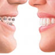 Ортодонтия - исправление прикуса фотография