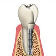Несъемное протезирование зубов