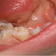 Лечение молочных зубов фото