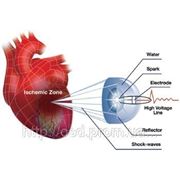 Ударно-волновая терапия сердечно-сосудистых заболеваний Кардиоспек (Cardiospec) фото