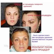 Коррекция перманентного макияжа с помощью лазера! фото