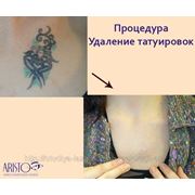 Удаление татуировок фото
