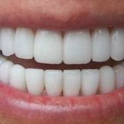 Реставрация зубов фотография