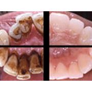 Удаление зубного камня ультразвуковым скалером в алматы фотография