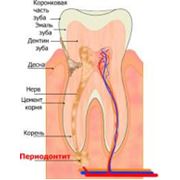 Периодонтит фото