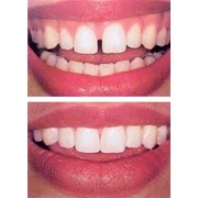 Лечение кариеса, некариозных поражений зубов фотография