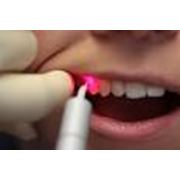 Лазерная стоматология фотография
