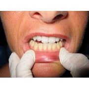 Безболезненное профессиональное отбеливание зубов. фото