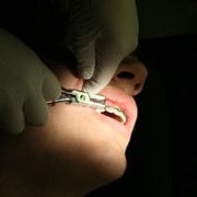 Лечение пульпита/ периодонтита молочного зуба