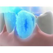 Озонотерапия зубов фото