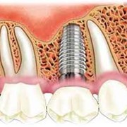 Имплантанты зубов Bio Horizons (США) фото