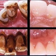 Удаление зубного камня или профессиональная чистка зубов ультразвуком.