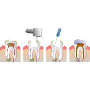 Пломбирование зубного канала