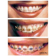 Ортодонтия (исправление положения зубов и прикуса) фотография