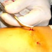Малоинвазивная хирургия вен