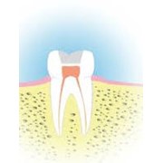 Пломбирование корневых каналов зубов