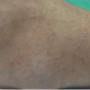 Склерозирование мелких сосудов ног.Лазеротерапия фото