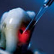 Лечение и реставрация зубов лазером фото
