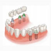 Протезирование зубов в алматы