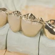 Протезирование зубов несъемное фото