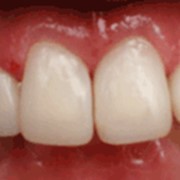 Эстетическая реставрация зубов (художественная реставрация зубов)