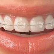 Выравнивание зубов