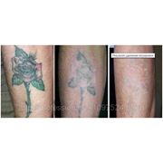 Удаление татуировок лазером. перманентный макияж (+анестезия) фото