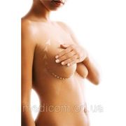 3D-нити, мезонити – подтяжка, омоложение груди на 2 года фото